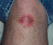 Banged Up Knee